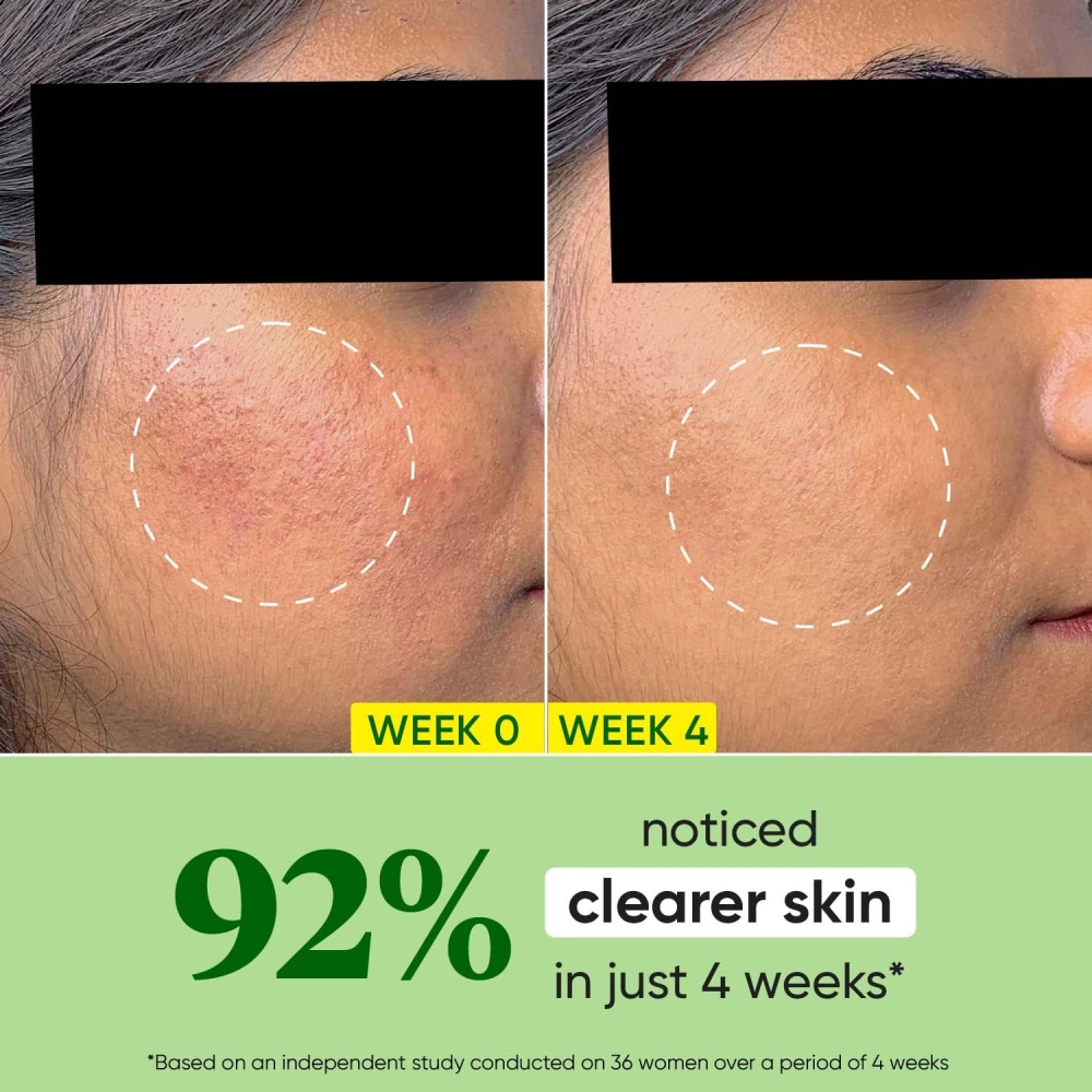 Dot & Key Cica + Niacinamide Oil-Free Face Moisturizer For Calm, Acne Free Hydrated Skin Fades Acne Scars & Dark Spots, Soothes Redness & Irritation | For Oily, Acne Prone & Sensitive Skin | 60Ml